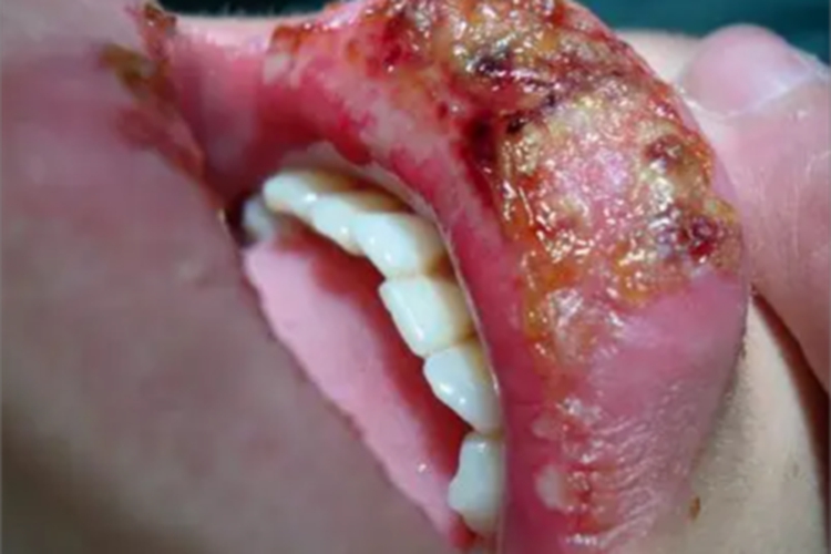 皮肤利什曼病嘴唇糜烂图