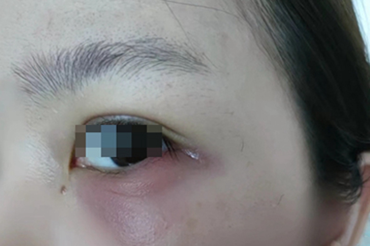 过敏性眼睑皮肤炎下眼睑红肿图
