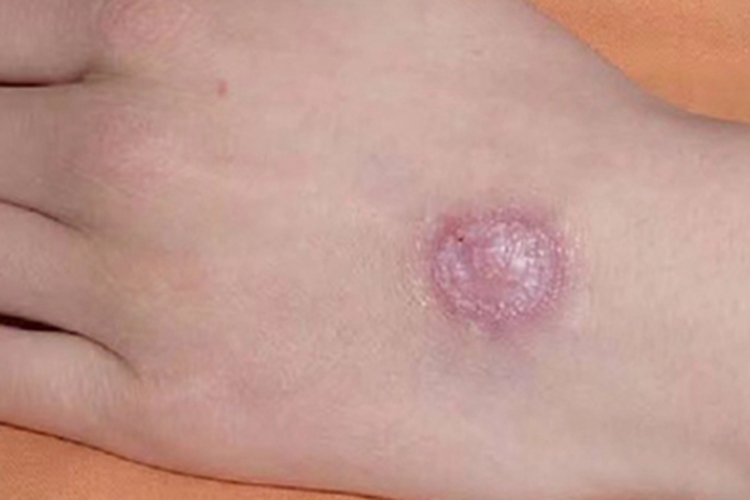 牛痘疤痕图 牛痘疤痕图