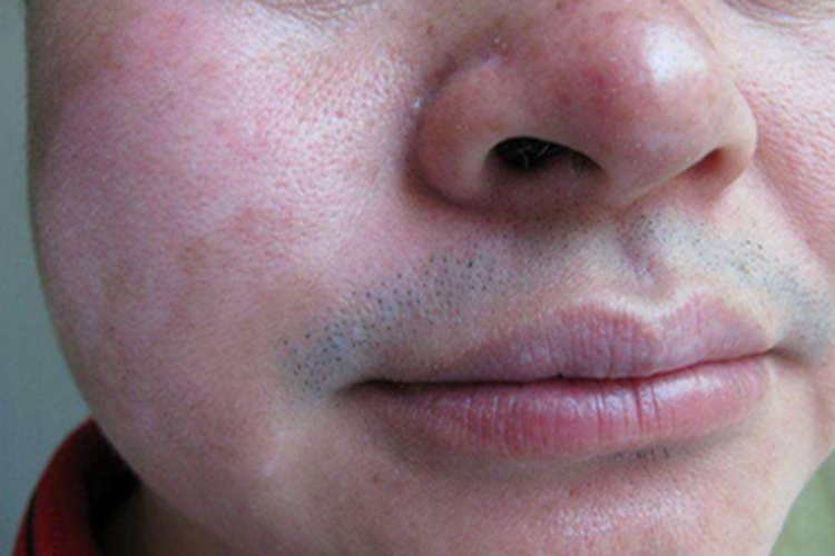 面肢端型白癜风面部症状图 面肢端型白癜风面部症状图