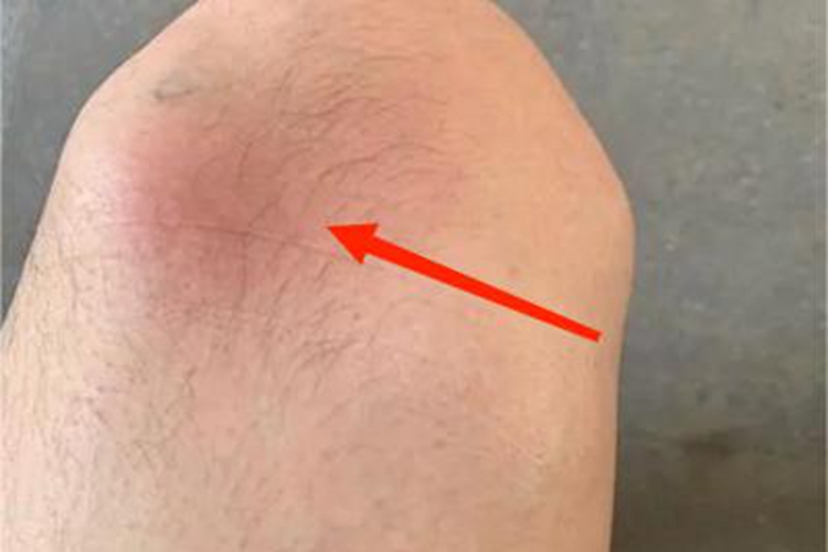 脂肪瘤大腿结节图