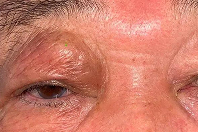 眼眶肿瘤眼睑肿块图 眼眶肿瘤眼睑肿块图