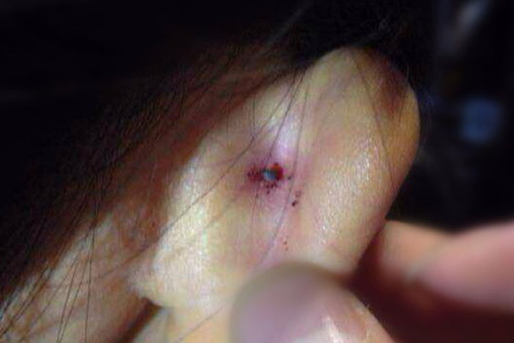 被蜱虫咬后十天伤口结节图