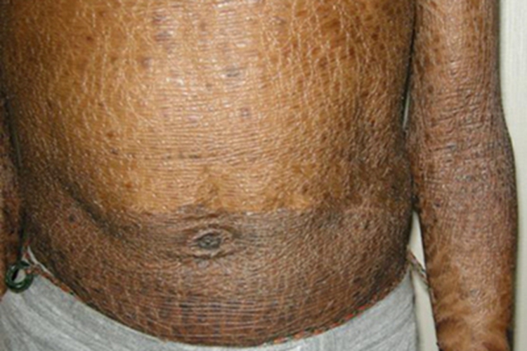 鱼鳞病腹部皮肤发黑图