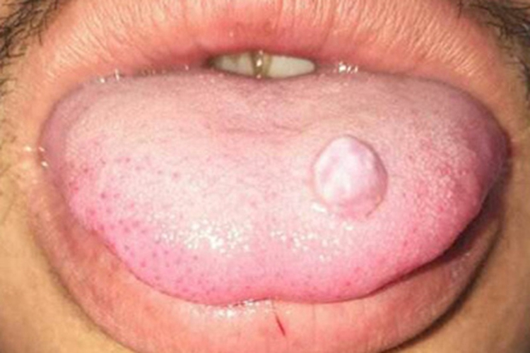 舌癌舌头肿块图 舌癌舌头肿块图