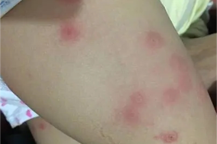 桑毛虫皮炎大腿红斑图