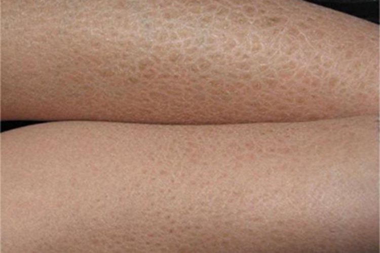 糙皮病胳膊皲裂图 糙皮病胳膊皲裂图