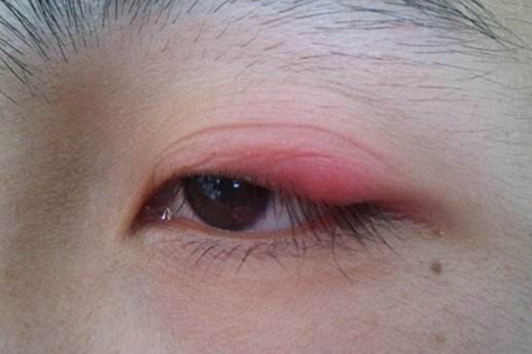 溃疡性睑缘炎图