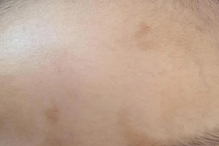 太田痣额头有浅褐色斑片图