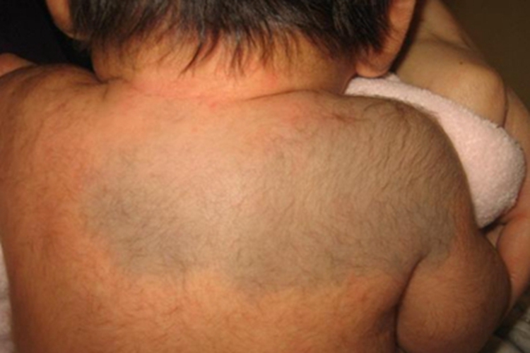 伊藤痣背部斑图