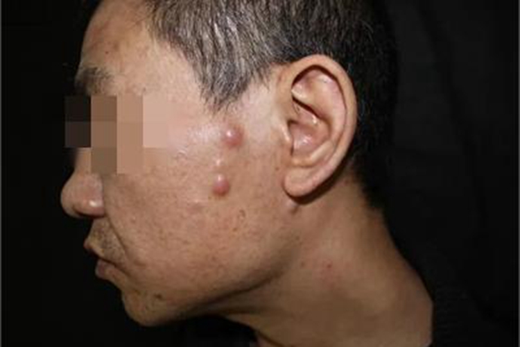 皮肤转移癌面部症状图