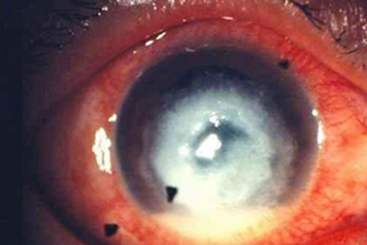 真菌性角膜炎眼球有圆形白斑图 真菌性角膜炎眼球有圆形白斑图