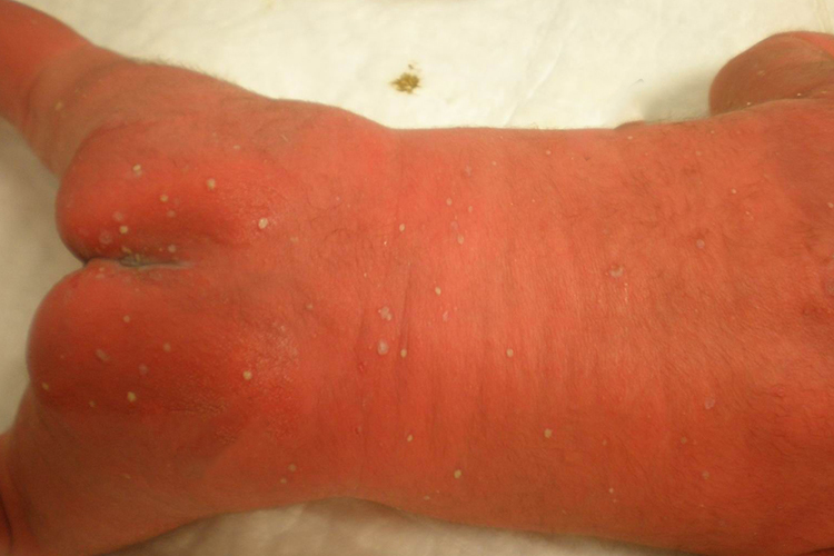 新生儿脓疱疮图