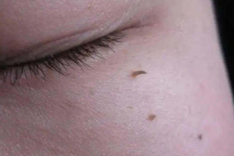 面部丝状疣图片 面部丝状疣图片