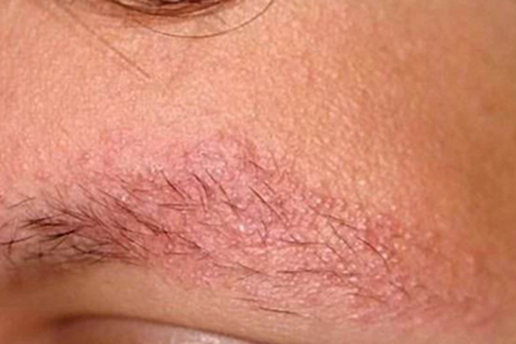 面部萎缩性毛周角化病症状图