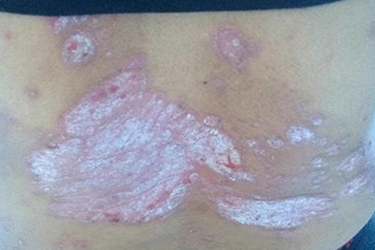 寻常型银屑病背部症状图