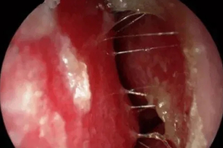 鼻黏膜糜烂充血图 鼻黏膜糜烂充血图