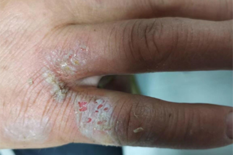急性湿疹小拇指糜烂发白图 急性湿疹小拇指糜烂发白图
