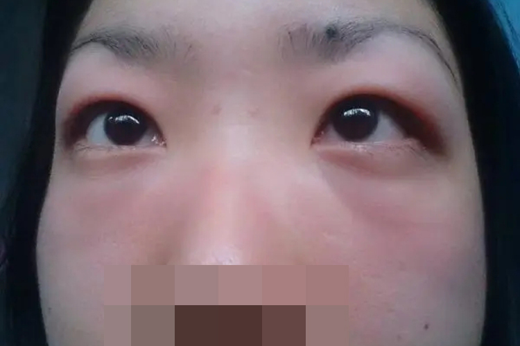 生理性眼睑水肿图