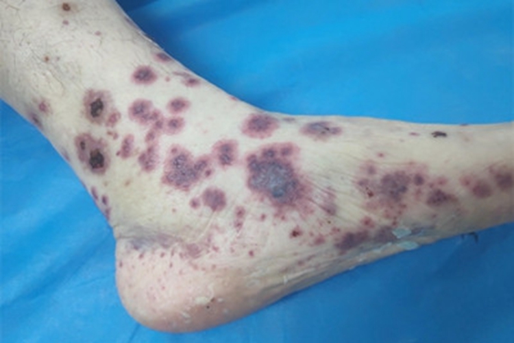 变应性皮肤血管炎紫癜图