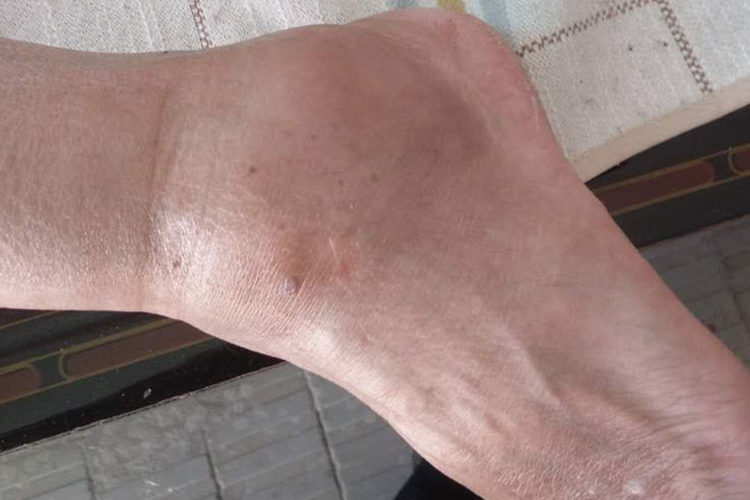 踝部滑膜炎疼痛肿胀图