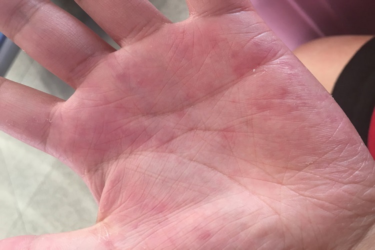 持久性隆起性红斑手掌斑图