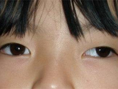 先天性共同性外斜视的症状和图片 - 有来医生