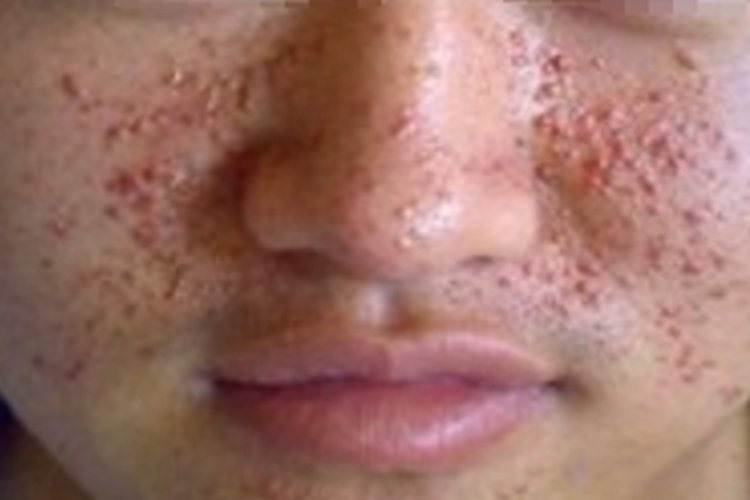 穿通性疾病面部丘疹图
