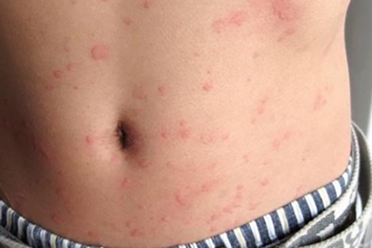 碘疹腹部红斑图