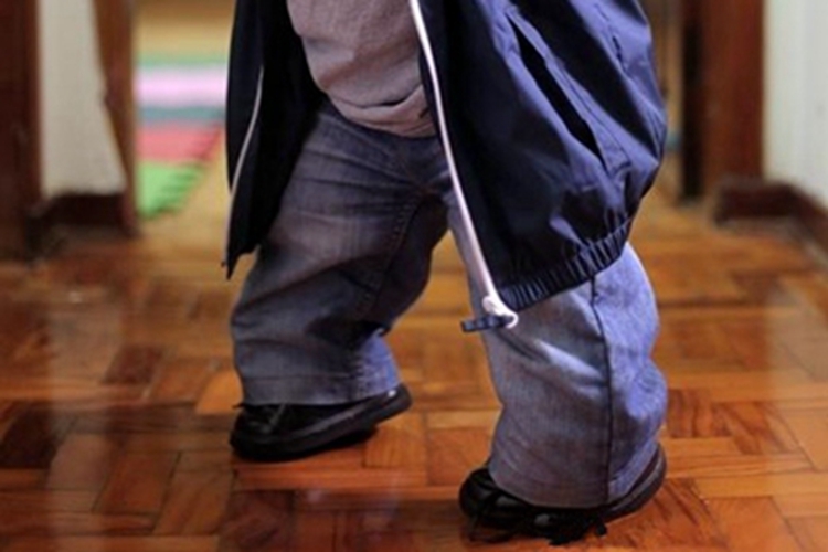 短肢侏儒免疫缺陷腿部短缩图