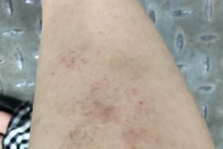 月经疹小腿症状图