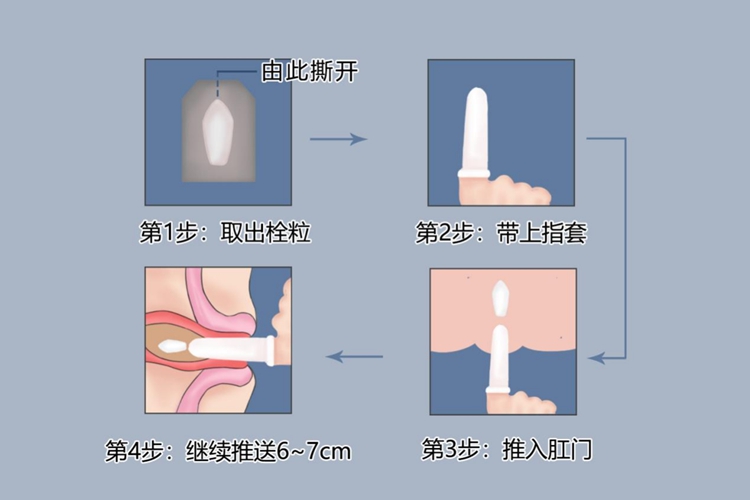 吲哚美辛栓使用方法图