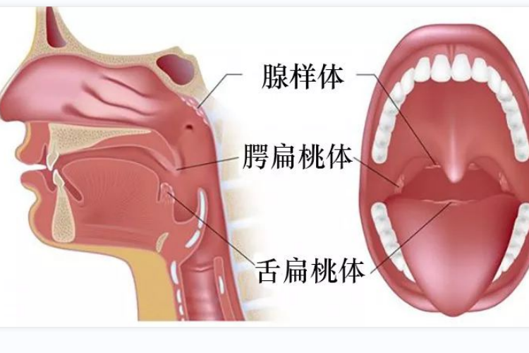 舌扁桃体肥大图