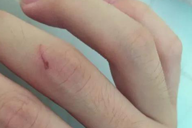 手被玻璃划伤图