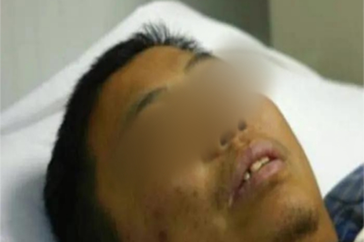 血色病皮肤颜色加深图