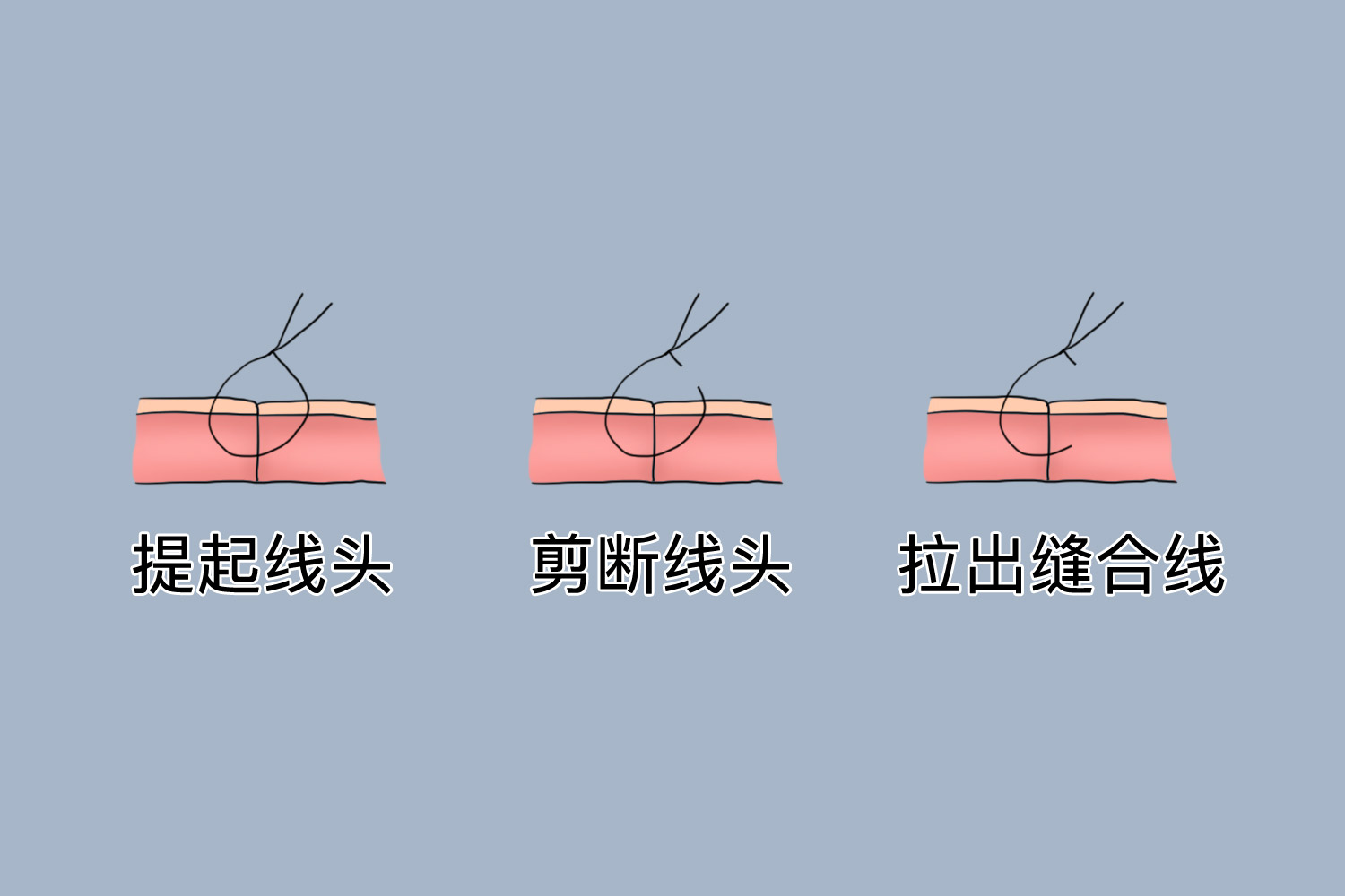 甲状腺手术拆线方法图