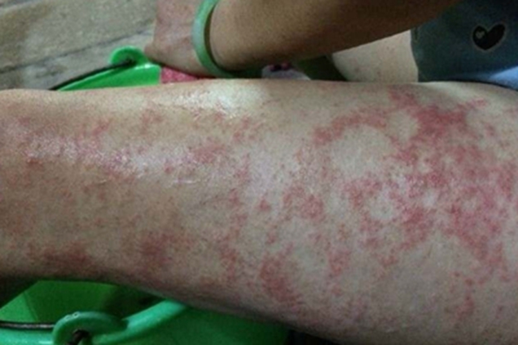 亚急性湿疹大腿小疙瘩图