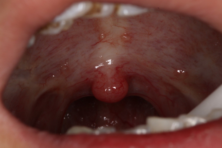 口腔黏膜下纤维性变图 口腔黏膜下纤维性变图