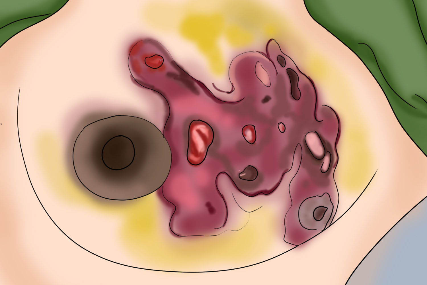 乳腺炎乳房小坑手绘图 乳腺炎乳房小坑手绘图