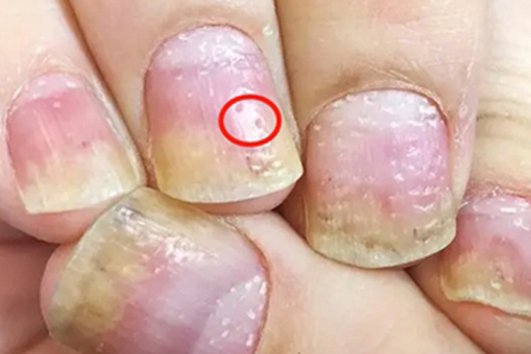 甲凹点手指甲小坑图