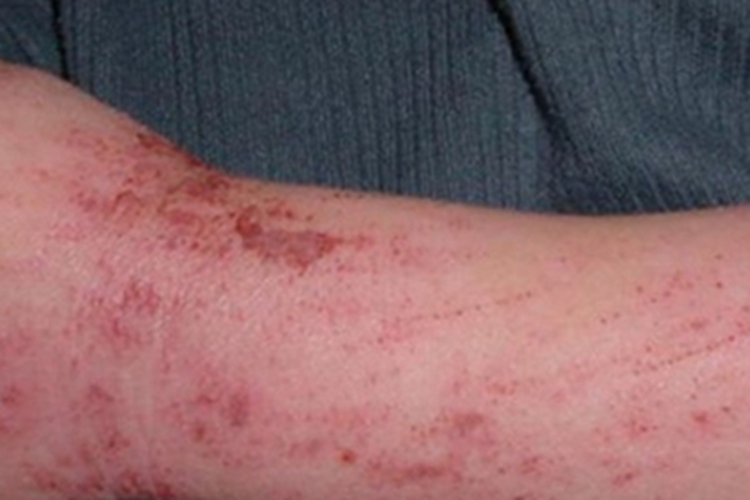 日光性皮炎胳膊结血痂图