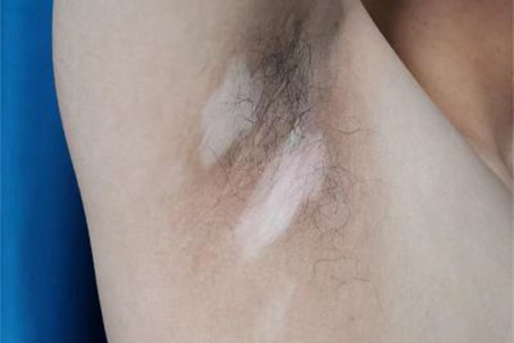 白癜风腋窝白斑图