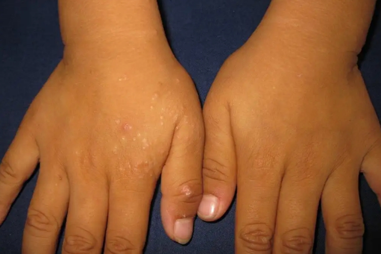 摩擦性苔藓样疹图 摩擦性苔藓样疹图