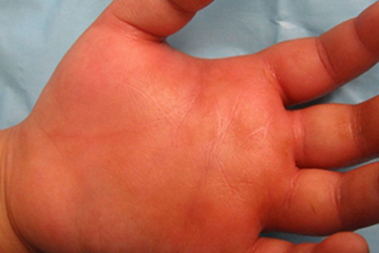 蝎蜇伤手掌症状图