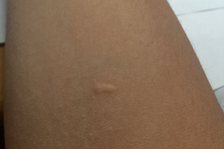 斑状萎缩胳膊小疙瘩图 斑状萎缩胳膊小疙瘩图