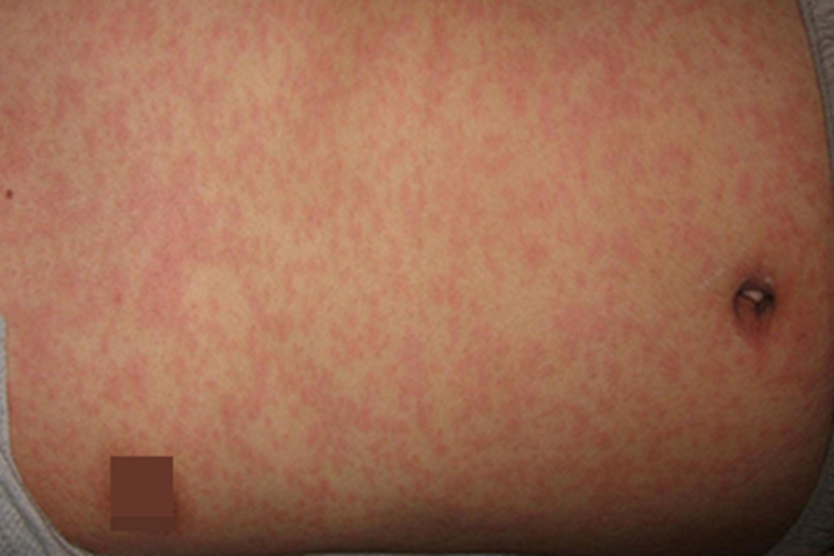 麻疹腹部疙瘩图 麻疹腹部疙瘩图