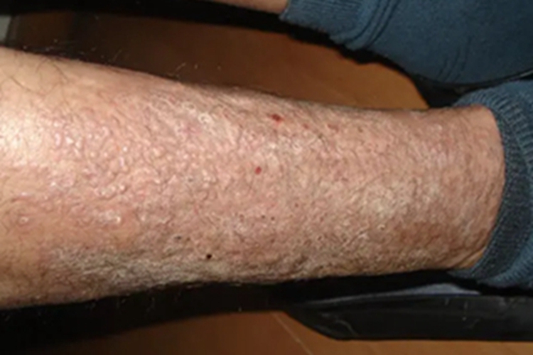 慢性湿疹小腿起皮图