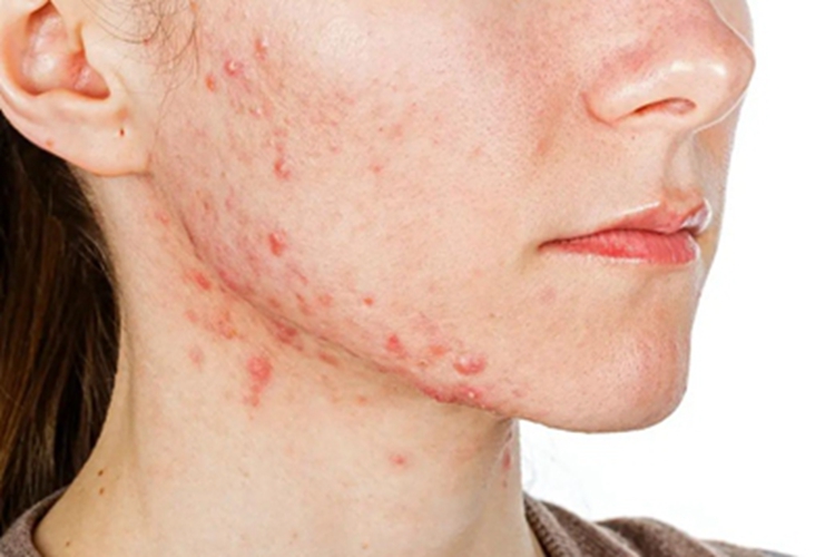 痤疮脸上长了一片小红疙瘩图 痤疮脸上长了一片小红疙瘩图