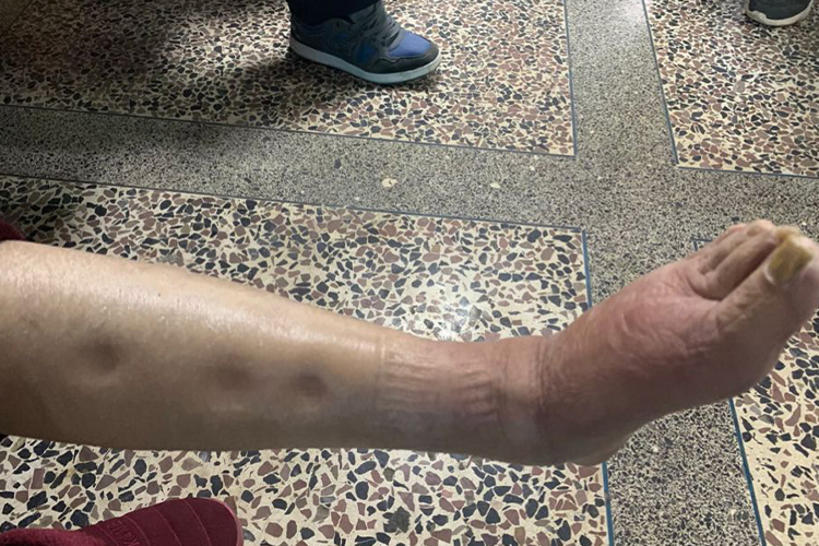 下肢深静脉血栓脚趾坏死初期图