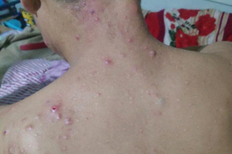 项部瘢痕疙瘩性毛囊炎后颈疙瘩图 项部瘢痕疙瘩性毛囊炎后颈疙瘩图